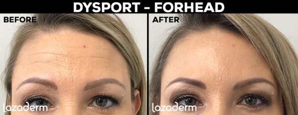 Dysport Injectable