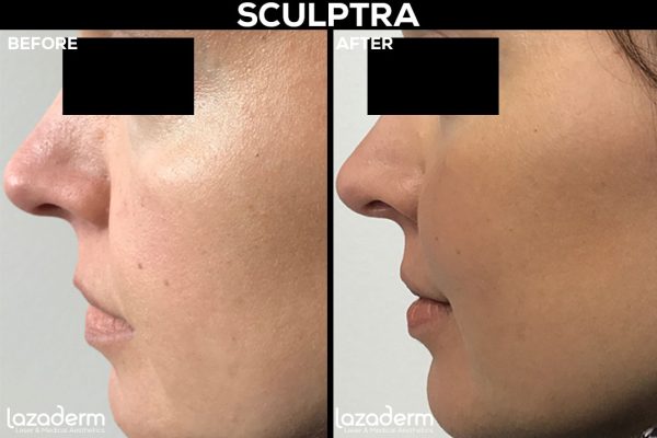 Sculptra