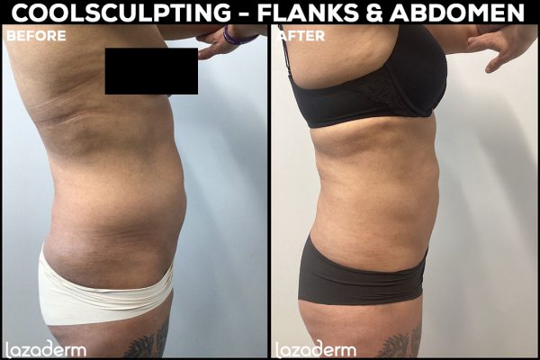CoolSculpting