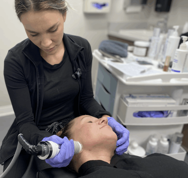 Secret RF Microneedling
